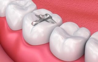 Detailed information on dental filling types, helping you choose the right filling for your dental health.