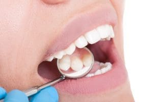 Solutions and expert advice for dealing with a dental filling falling out, ensuring proper treatment and relief.