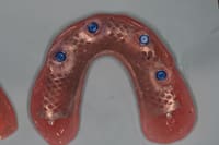 Upper Denture